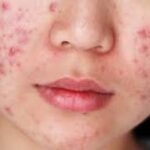 Mengapa Wajah Jerawatan Setelah Skincare Baru? Ini Penjelasan Dokter Kulit